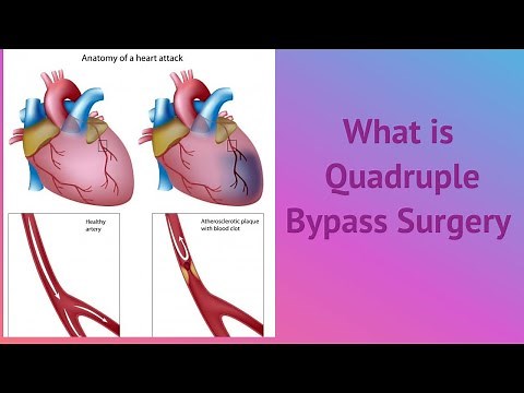 What is Quadruple Bypass Surgery