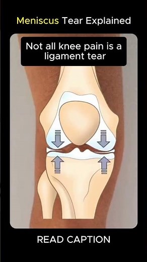 Twisted Your Knee? 😨 This Hidden Shock Absorber Might Be Torn! | Meniscus Tear Explained