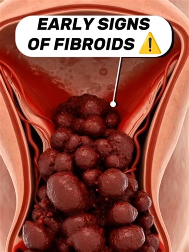 Recognizing Early Signs of Fibroids