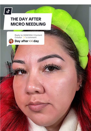 Replying to @VANESSA l Content Creator ✨ I used the cleanser , toner and vitamin c the next day after micro needling.