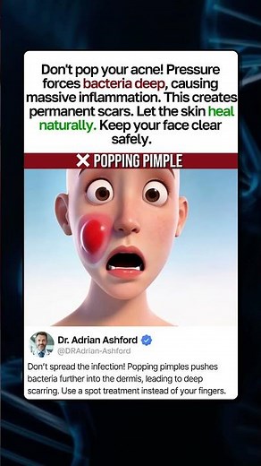 Why You Must STOP Popping Pimples! #facts #health #beauty #acne