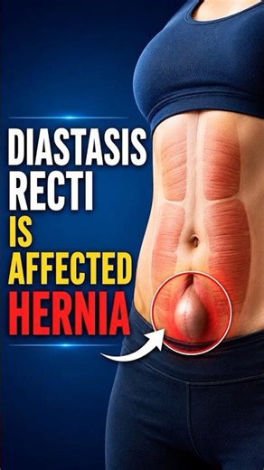 Diastasis recti and hernia explained #diastasisrecti #diastasisrectirecovery #hernia