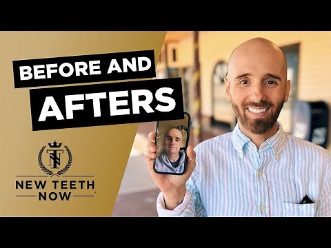 Amazing Dental Implant Before and Afters | New Teeth Now