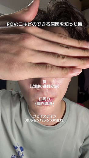 ニキビのできる原因とケア方法