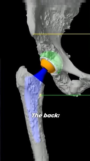 Inside 3D Virtual Hip Replacement Surgery⁉️