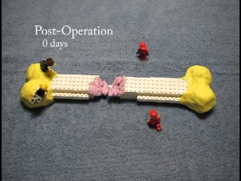 A stop animation film about bone morphogenetic protein (BMP) and fracture healing
