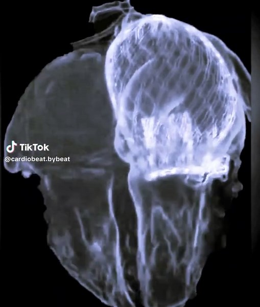 Revolutionising Mitral Valve Treatment with AltaValve