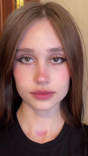 Understanding Bruises: Causes and Concerns Explained