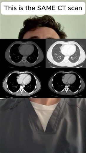 How CT Windowing Actually Works