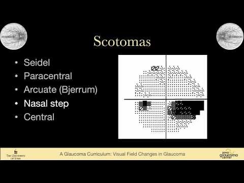7 EXAMINATION Visual Field Changes in Glaucoma