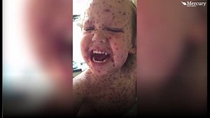 Two-year-old Jasper from St Neots spent five days in hospital, with the "worst chicken pox doctors had ever seen". http://bbc.in/2af6N6M | BBC Norfolk