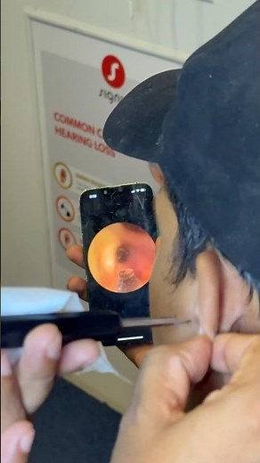 “Ear Dome Stuck in Ear? Safe Hearing Aid Removal by Expert Audiologist”