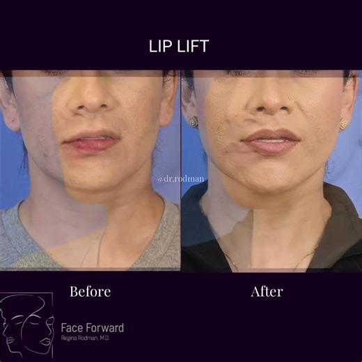 Lip Lift| Before and After| Facial Plastic Surgery