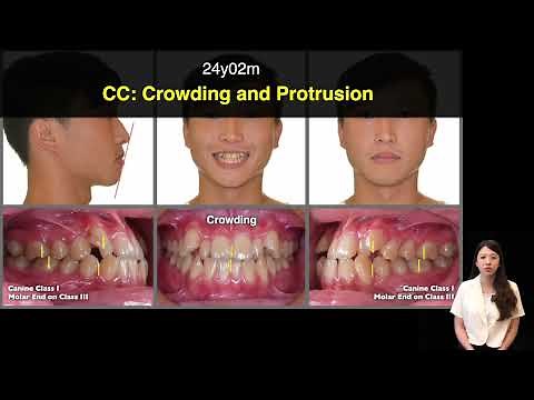 Pseudo-CIass III with a functional shift |【Chris Chang Ortho】CC835