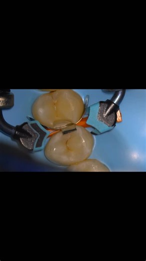 T Δ Η Δ on Instagram: "Showing the new QUAD system from @garrisondentalsolutions with some @aquacare_ and the classic @tokuyamadentalgermany learn how to use the right system at the right time on the direct posteriors course email dentistrybythomas@dr.com for more information"