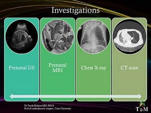 Congenital anomalies of the lung