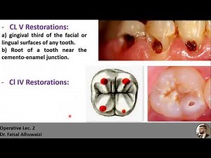 Operative Lec. 2, Classification of Cavities & Class I cavity