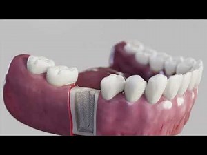 Mastering the DESS® CONICAL BLT Implant Surgical Protocol