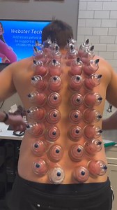 1.2M views · 9.2K reactions | cupping therapy..... . . . . #cupping #therapy #newvideo #reels #viralvideo #viralhack #old #facts #fyp #reels #insta #fbgood #fypシ゚viralシ | Deep Access | Facebook