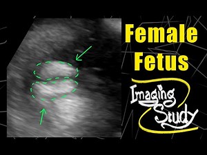 Female Fetus - It's a Girl || Ultrasound || Case 101
