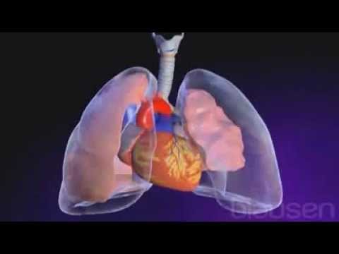 Neumotorax Traumático.