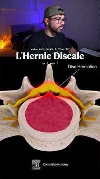 ⚡️ 1 MIN pour comprendre ce qu’est une HERNIE DISCALE 🤯 #anatomie #sciatique #herniediscale