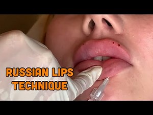 How to do Russian lips - treatment snicks and tutorial