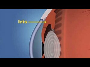 Iridotomy
