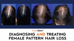 Diagnosing and Treating Female Pattern Hair Loss