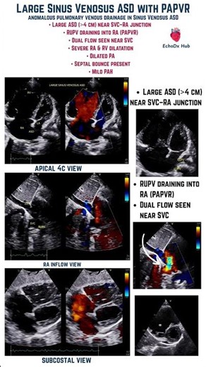 Large Sinus Venosus ASD with PAPVR #echocardiography