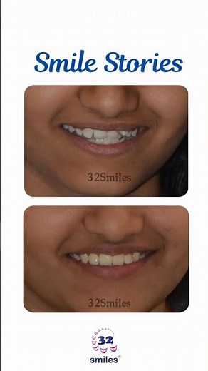A smile transformation you can truly see! 😁✨From crowded teeth to perfect alignment 🦷🌟Another