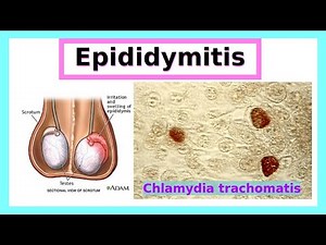 epididymitis