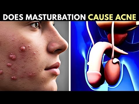Does Masturbation Cause Acne or Pimples | Myths And Facts Backed By Science