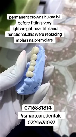 Permanent porcelain bridge