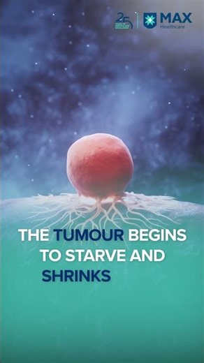 How TACE Treats Liver Tumours Without Surgery