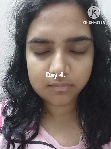 Wisdom Tooth🦷 Extraction surgery😱😭 Recovery Time🤕
