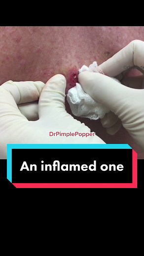 Dealing with Inflamed Cysts: Tips and Tricks