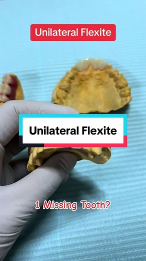 Isang Bungi sa Harap o Likod ng Ngipin: Unilateral Flexite Denture at ang Iba't ibang Benepisyo Nito