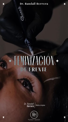 La feminización de la frente transforma sutilmente la armonía del rostro ✨ Karina Torres luce ahora más femenina, elegante y radiante 💖 @karina.torrea #frentedechava #femenizacion #rellenodefrente #acidohialurónico #perdidas #karinatorres | Dr. Randall Herrera