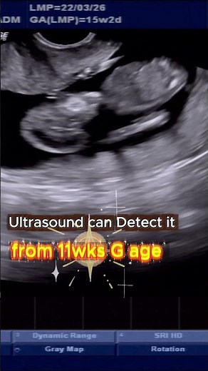 Anencephaly - How Early Can It Be Diagnosed?