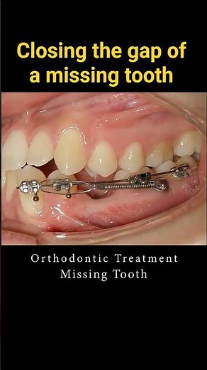 Missing tooth and a Miniscrew (TAD) #braces #dentist #smilemakeover #dentalcare #orthodontics