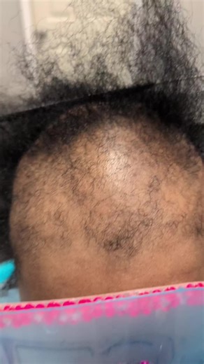 TheAlopeciaSpecialist on TikTok