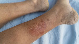 Comment reconnaître l'érysipèle et comment traiter cette infection de la peau ? - RTBF Actus