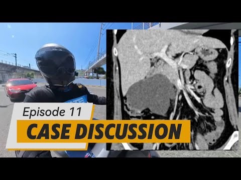 Case Discussion Episode 11: A Case of a Retroperitoneal Cyst