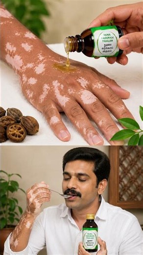 White Patches on Skin?