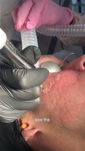 Phase 4 Acne Scar Case by Dr. Qazi