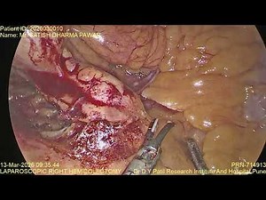 Satish Laparoscopic right Hemicolectomy