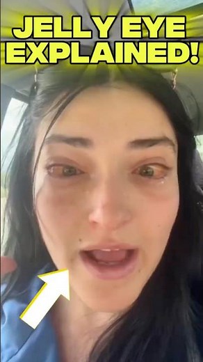 What If Your Eye Turned to Jelly?#EyeHealth #MedicalFacts #HealthAwareness