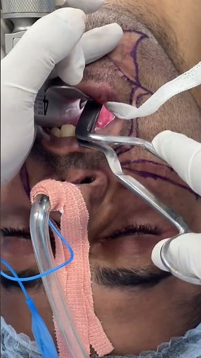 Throat pack being done
