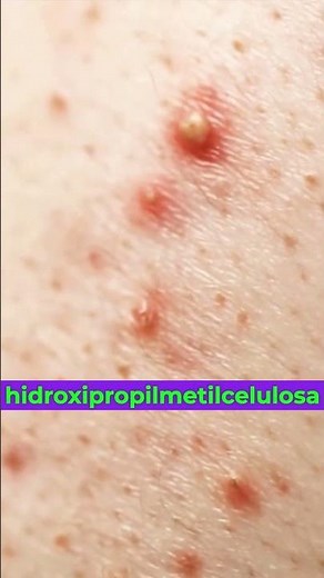 Gel acné clindamicina